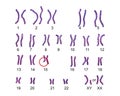 Karyotype of Angelman syndrome