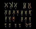 Karyotype of Angelman syndrome