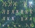 Karyotype of Cri du chat, or cat's cry, syndrome, also known as 5p- syndrome