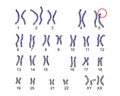 Karyotype of Cri du chat, or cat's cry, syndrome, also known as 5p- syndrome