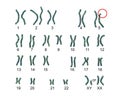 Karyotype of Cri du chat, or cat's cry, syndrome, also known as 5p- syndrome