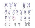 Karyotype of Prader-Willi syndrome Royalty Free Stock Photo