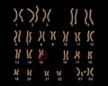 Karyotype of Prader-Willi syndrome
