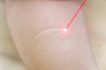 Keloid or scar with laser remove skin care medical