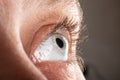 Keratoconus eye closeup , thinning of the cornea Royalty Free Stock Photo