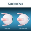 Keratoconus. eyes disorder Royalty Free Stock Photo