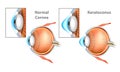 Keratoconus KC Cornea. Royalty Free Stock Photo