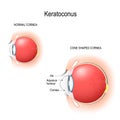 Keratoconus. Normal cornea and cone shaped cornea