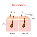 Keratosis pilaris. lichen pilaris and hair follicle