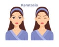 Keratosis.Pretty Face. Skin disease.Treatment. Woman with open eyes and closed.