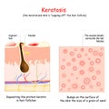 Keratosis. Skin disease