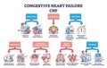 Key aspects of congestive heart failure or CHF explanation outline diagram Royalty Free Stock Photo