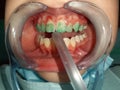 Kid girl sitting at dental chair with open mouth closeup during procedure to apply braces to teeth. Visiting dentist