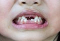 A kid losing baby teeth