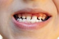 Kid open mouth showing caries teeth. Child teeth close up