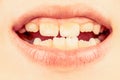 Kid patient open mouth showing cavities teeth decay. Bad teeth child. Portrait boy with bad teeth. Close up of unhealthy