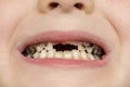 Kid patient open mouth showing cavities teeth decay. Close up of unhealthy baby teeth. Dental medicine and healthcare