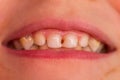 Kid patient open mouth showing cavities teeth decay. Close up of unhealthy baby teeth. Dental medicine and healthcare - human Royalty Free Stock Photo