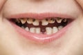 Kid patient open mouth showing cavities teeth decay. Close up of unhealthy baby teeth. Dental medicine and healthcare - human Royalty Free Stock Photo
