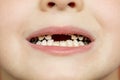 Kid patient open mouth showing cavities teeth decay. Close up of unhealthy baby teeth. Dental medicine and healthcare - human Royalty Free Stock Photo