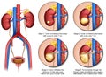 Kidney cancer 3d medical vector illustration with description isolated on white background with urinary system