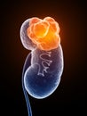 Kidney cancer Royalty Free Stock Photo