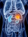 Kidney cancer