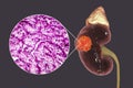 Kidney cancer, illustration and light micrograph