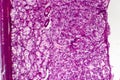 Kidney cancer, light micrograph Royalty Free Stock Photo