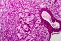 Kidney cancer, light micrograph Royalty Free Stock Photo