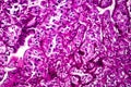 Kidney cancer, light micrograph Royalty Free Stock Photo