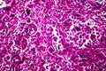 Kidney cancer, light micrograph Royalty Free Stock Photo