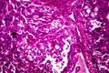 Kidney cancer, light micrograph Royalty Free Stock Photo