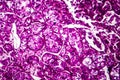 Kidney cancer, light micrograph