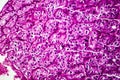Kidney cancer, light micrograph Royalty Free Stock Photo