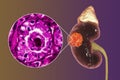 Kidney cancer, illustration and light micrograph