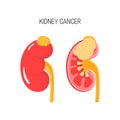 Kidney cancer vector concept Royalty Free Stock Photo