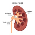 Kidney cartoon stones disease vector infographic. Urinary renal kidnay stone surgey background anatomy failure Royalty Free Stock Photo