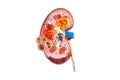 Kidney disease, Chronic kidney disease ckd, model for study isolated on white background with clipping path