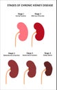 Kidney disease concept