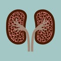 Kidney disease silhouette icon. Stones in the kidneys. Pyelonephritis. Urolithiasis disease