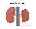 Kidney failure chronic disease urinary renal cancer. Kidney failure nephritis nephrosclerosis.