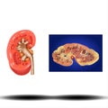 Kidney - internal organ, Kidney stones. Renal calculi, nephrolithiasis or urolithiasis, vector illustration on white background