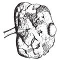 Kidney showing advanced chronic interstitial nephritis, vintage engraving
