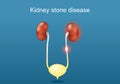Kidney stone disease Royalty Free Stock Photo