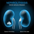 Kidney stone disease. Renal calculus. Nephrolithiasis or urolithiasis Royalty Free Stock Photo