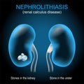 Kidney stone disease. Renal calculus. Nephrolithiasis or urolithiasis