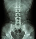 Kidney stone ( renal stone , renal calculi ) ( film x-ray KUB ( Kidney - Ureter - Bladder ) show left renal stone ) Royalty Free Stock Photo