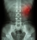 Kidney stone ( renal stone , renal calculi ) ( film x-ray KUB ( Kidney - Ureter - Bladder ) show left renal stone ) Royalty Free Stock Photo