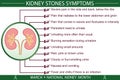 Kidney stones disease symptoms infographic vector illustration Royalty Free Stock Photo